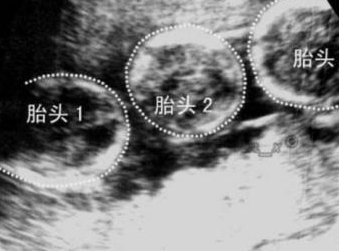 浙江试管婴儿好吗？